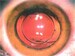 Posterior Polar Cataract
