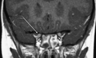 T1 contrast enhanced coronal section of the MRI sh