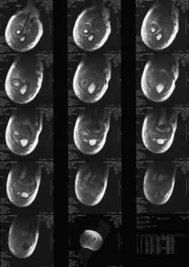 MRI demonstrating Milch type I fracture pattern. 
