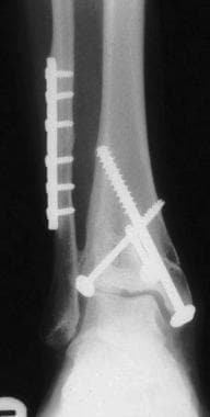 Pilon fracture stabilized by minimally invasive te