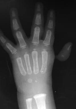 Radiograph of a pouce flottant thumb 
