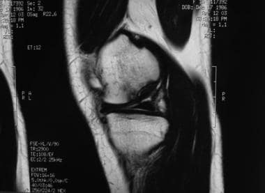 Osteochondritis dissecans. Sagittal view of an ost