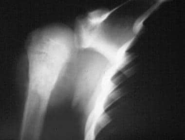 Radiographic appearance (plain radiograph) of a pr