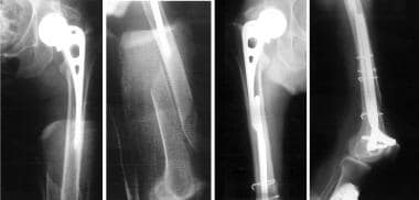 Fracture around stable prosthesis treated with fle