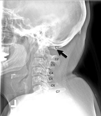 Occipitalization of atlas in a patient with Chiari