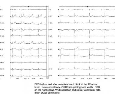 third degree heart block