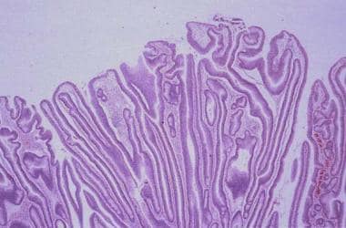 Histology of villous adenoma. Fingerlike projectio