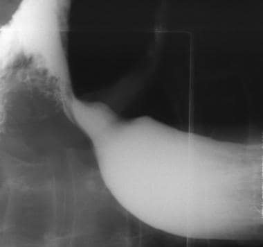 esophageal dysmotility