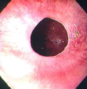 Esophagus: Normal Anatomy, Function and Congenital Anomalies | SpringerLink