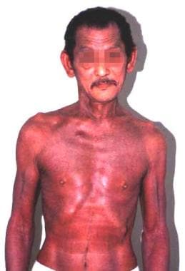 Erythroderma in a patient with hypereosinophilic s