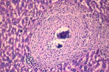 Granuloma in the liver due to Schistosoma mansoni.