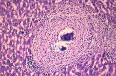 schistosomiasis uptodate