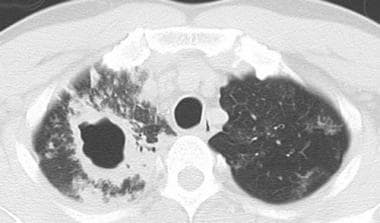 Axial chest computed tomography without intravenou