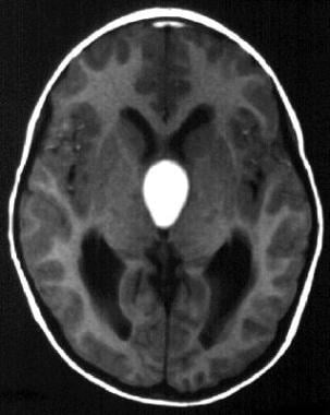 Axial MRI shows a craniopharyngioma cyst that cont