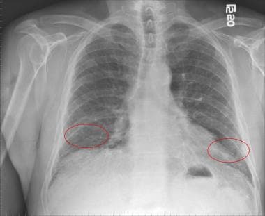 Chest radiograph of a patient with idiopathic pulm