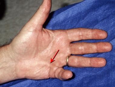 Dupuytren Contracture: Practice Essentials, Background, Anatomy