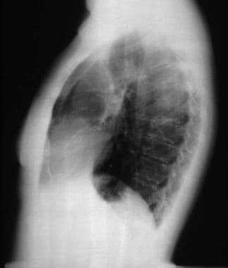 Lateral chest radiograph of a 37-year-old woman wi