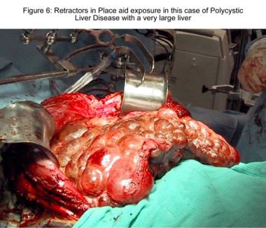 Liver transplantation. Retractors in place aid exp