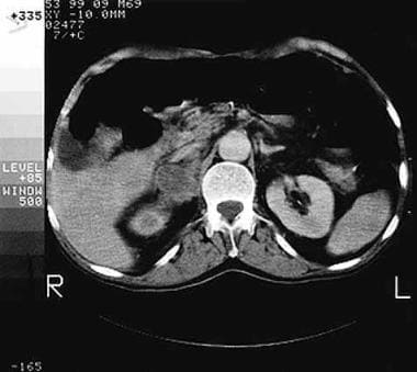 CT scan demonstrating metastatic upper tract uroth