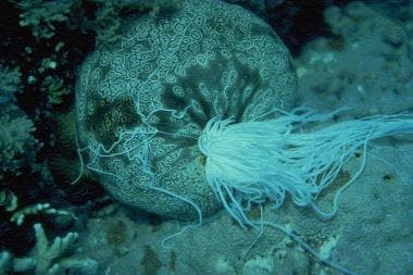 Echinoderm envenomations. The common and toxic sea