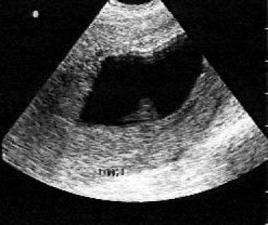 This endovaginal ultrasonogram reveals an irregula
