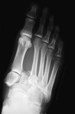 Fractures, foot. Lisfranc fracture-dislocation. 