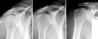 Normal plain radiograph of the shoulder in interna