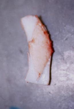 Note the diamond-shaped internal intraluminal comp