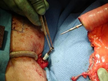 GI end-to-end anastomotic device used to couple th
