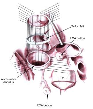 Placement of the pulmonary autograft into the aort