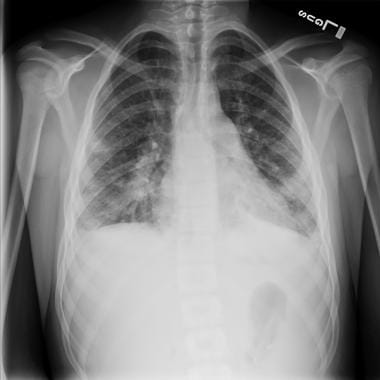 Samaritan Infectious Disease - Staphylococcus aureus Bacteremia