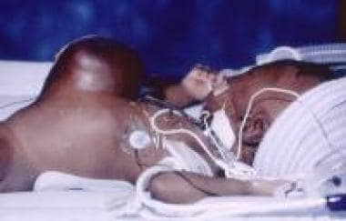 Pediatric omphalocele and gastroschisis (abdominal