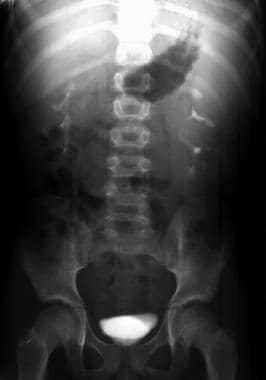 Excretory urogram shows enlarged kidneys with bila