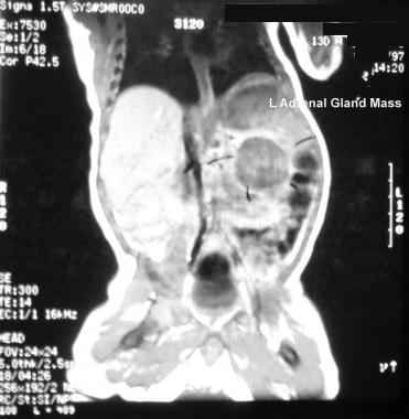 MRI of a left adrenal mass. The mass was revealed 