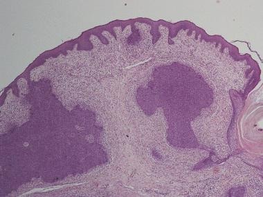 Basaloid follicular hamartoma. Courtesy of L Wozni