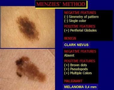 Application of Menzies method to evaluate the diff