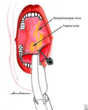 Intraoral anatomy and glossopharyngeal block techn