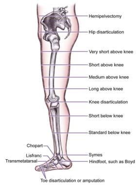The various levels of lower-extremity amputations.