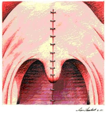 Immediate postoperative view from oral cavity. 