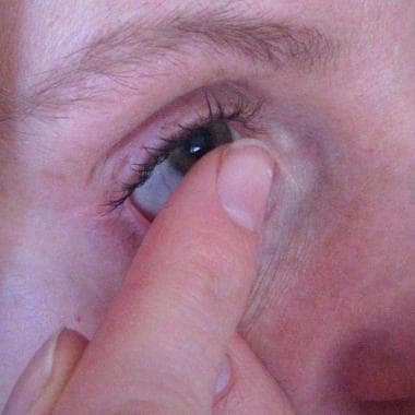 Touch the surface of the contact lens with an inde