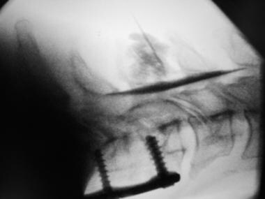 颈外尿路造影显示后硬膜外sp