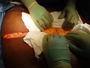 After incision through skin, laparotomy pads are p