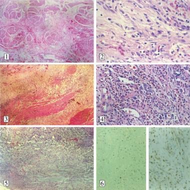 Microscopic findings of inflammatory myofibroblast