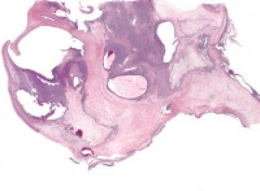 Granulosa cell tumor, macrofollicular pattern (hem