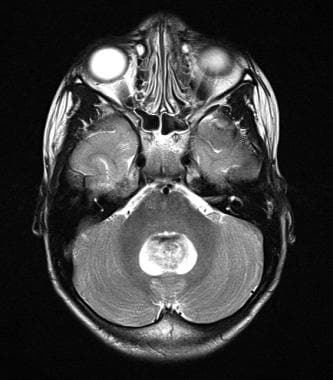 T2-weighted axial magnetic resonance image of a po