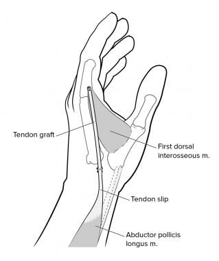 Tendon Transfer Principles and Mechanics: General Principles of Tendon ...