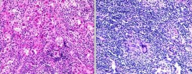 Pituitary Tumors Pathology. Hypophysitis. Left: Ly