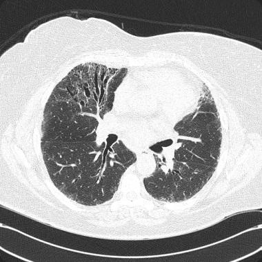 CT scan of chest in patient with acquired right mi