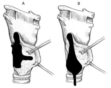Most common location of superior parathyroid (A) a