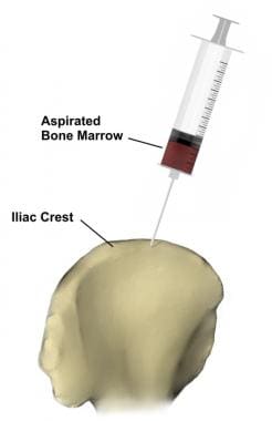 Illustration showing bone marrow aspiration from t